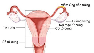 viêm ống dẫn trứng