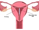 Những điều cần biết về đặt vòng tránh thai