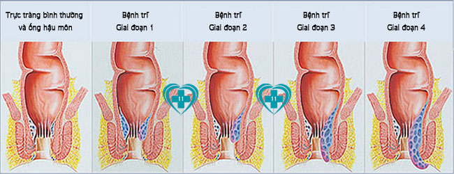 benh-tri-4-giai-doan