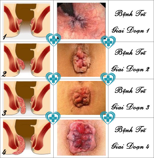 benhtri-ngoai-cac-giai-doan
