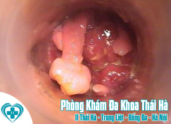 trieu-chung-polyp-hau-mon