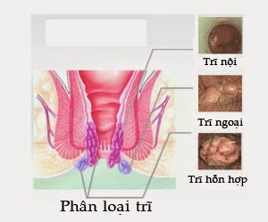 trieu-chung-tri-hon-hop