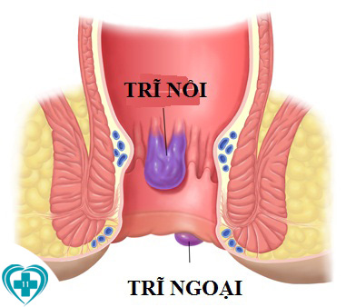 trieu-chung-tri-noi-tri-ngoai