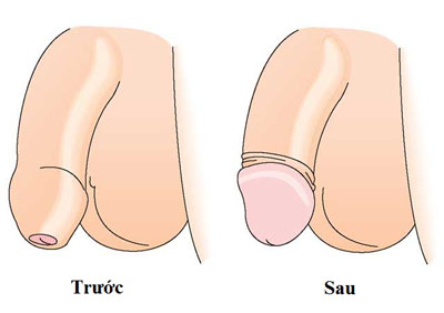 anhtruoc-va-sau-cat-bao-quy-dau1