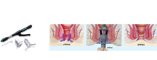 xâm lấn tối thiểu pph